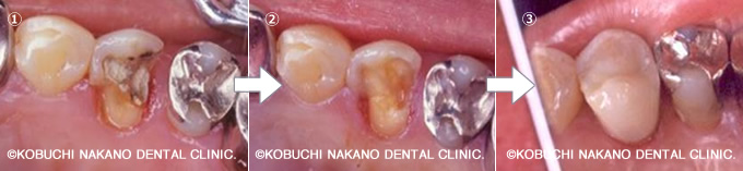 小臼歯の虫歯
